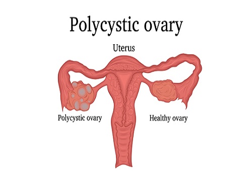 Polycystic Ovary Syndrome Affects The Quality Of Life