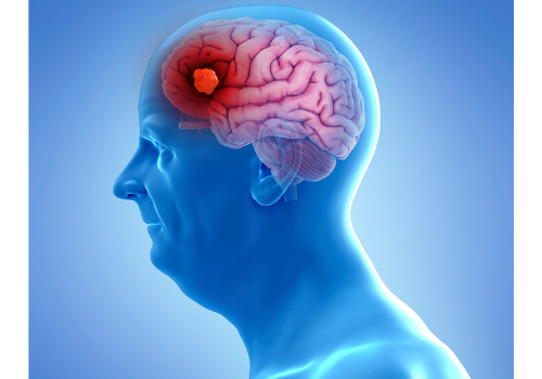 Ever Wondered How Tumours Develop In Brain? Read On!