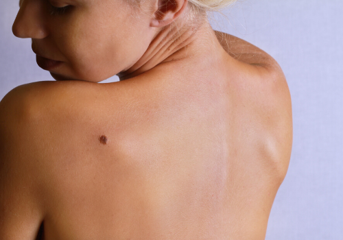 Fighting Melanoma - Here’s What You Should Know!