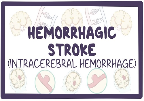 Intracerebral Hemorrhage - A Life Threatening Disease