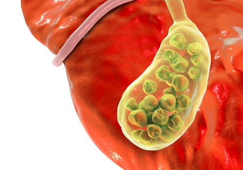 Suffering From Improper Liver Function? It Could Be GallStones