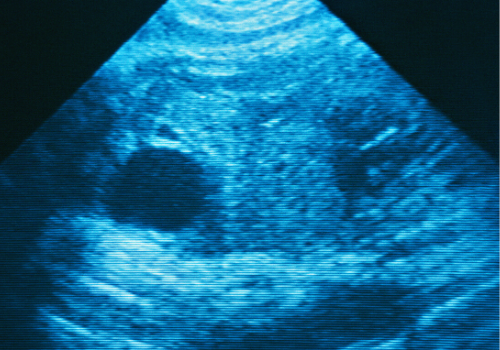 Fetal Bradycardia - Monitor Your Baby’s Heart Rate